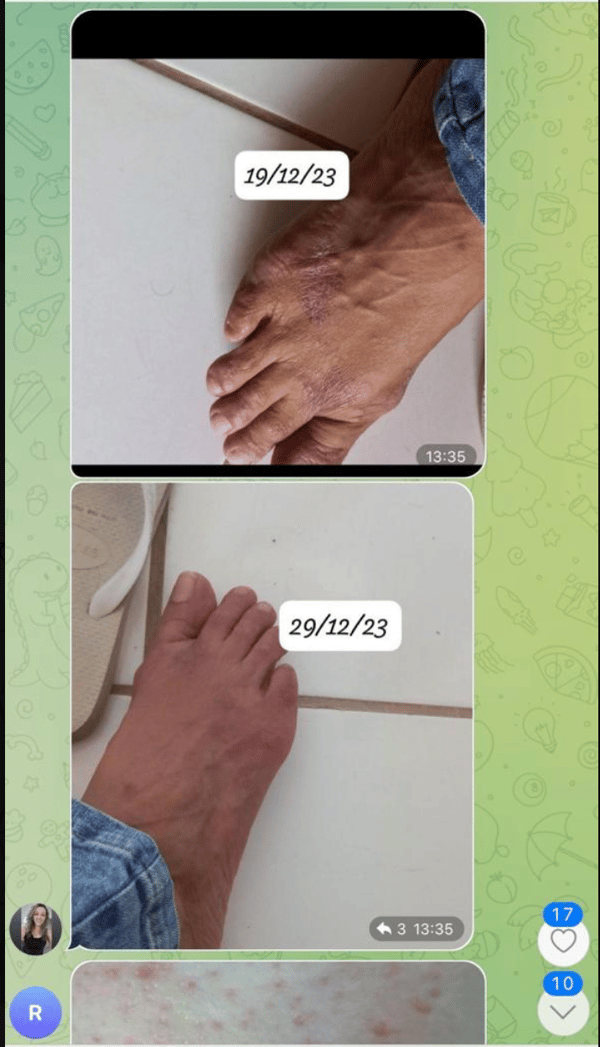 Antes e depois da psoríase 3