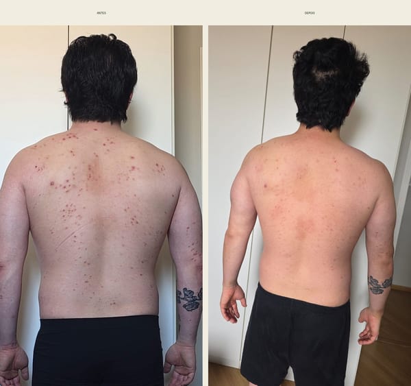 Antes e depois da psoríase 1