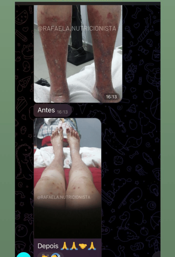 Antes e depois da psoríase 2