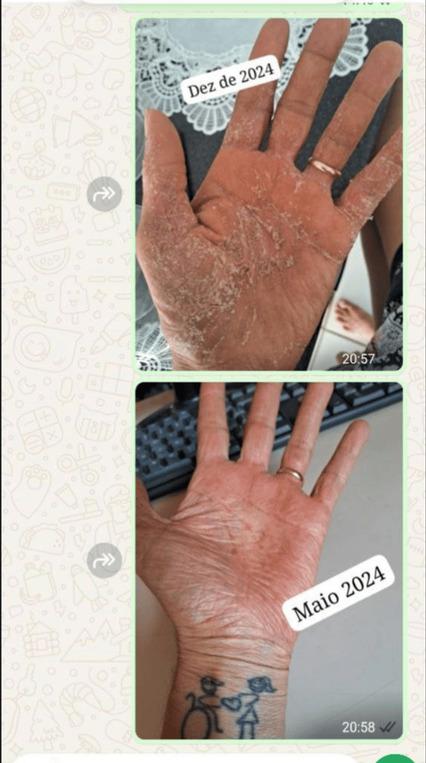 Antes e depois da psoríase 4